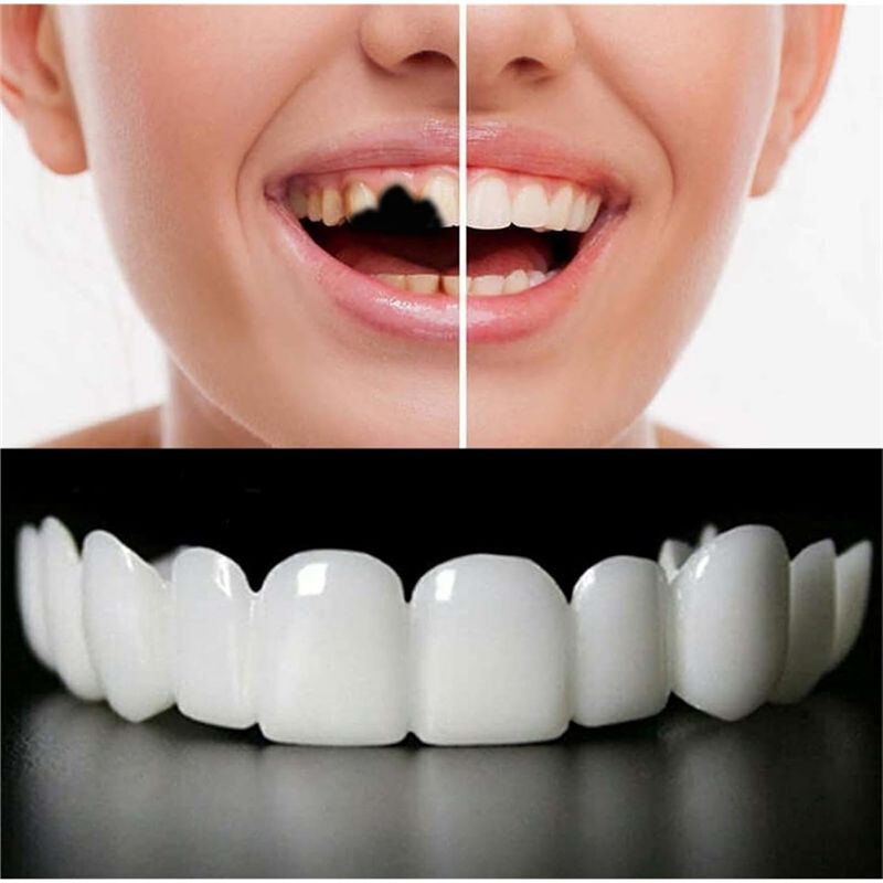 Carillas dentales temporales r - Teeth Whitening Uneven reseña y precio