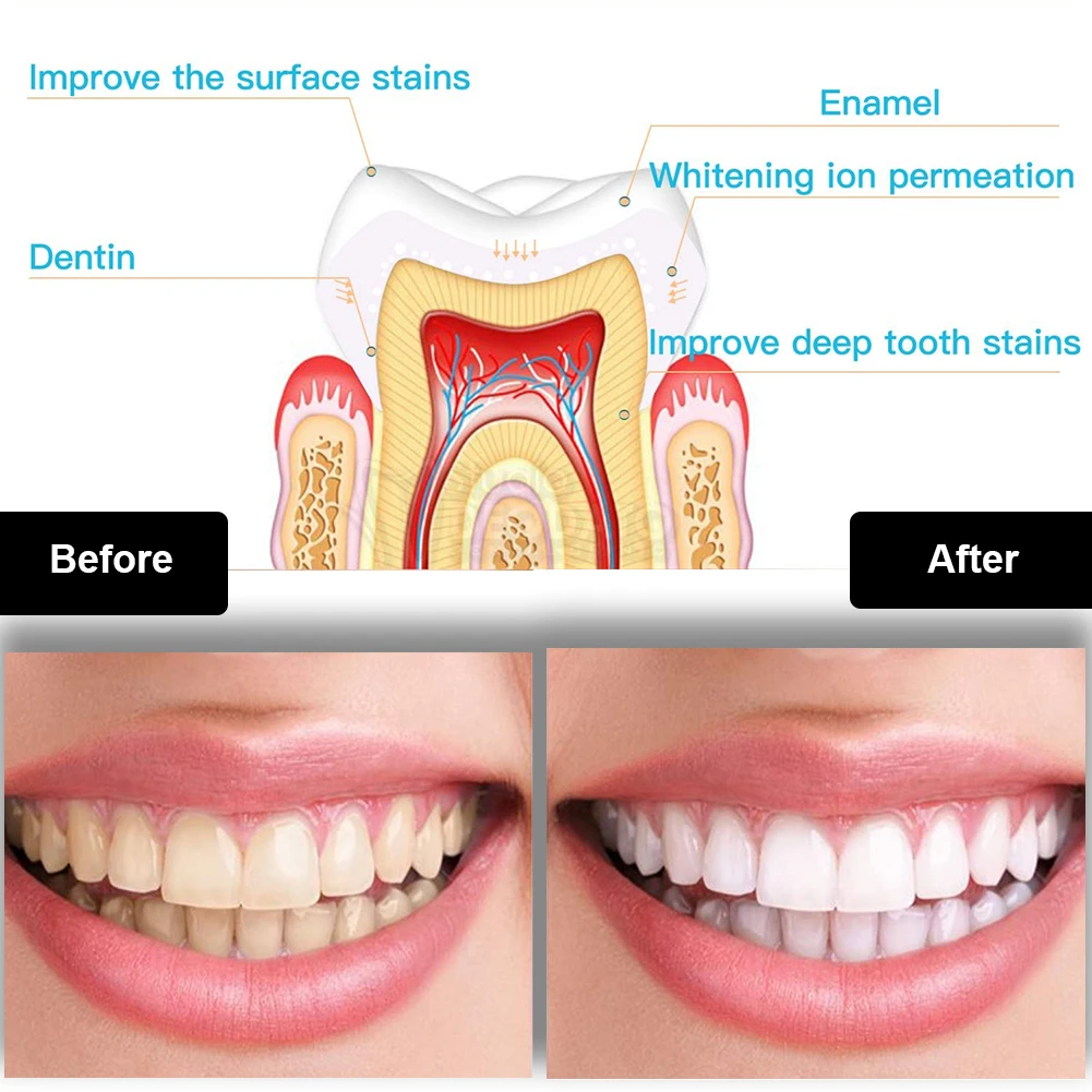 Kit de blanqueamiento Dental M - Teeth Whitening Ulta reseña y precio