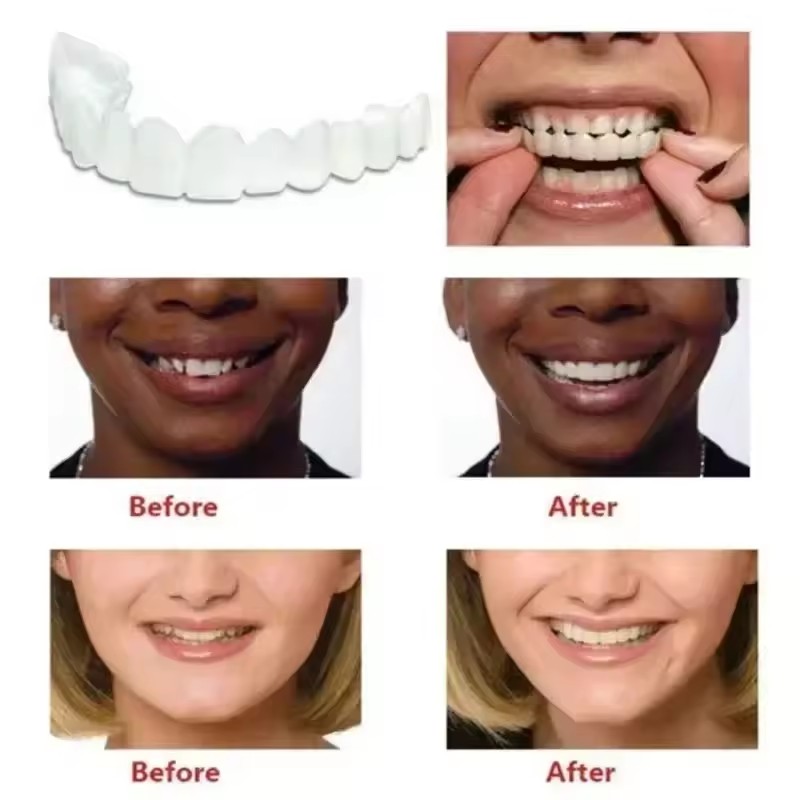 Nuevas carillas dentales tempo - Teeth Whitening Uneven reseña y precio